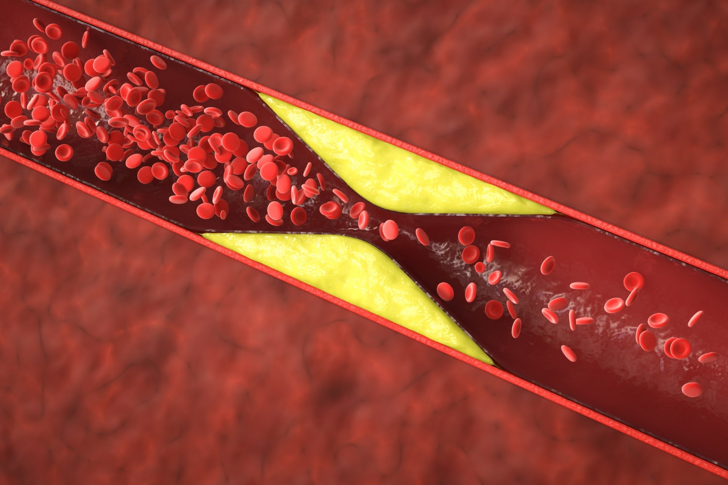 Cholesterin und arterielle Gesundheit